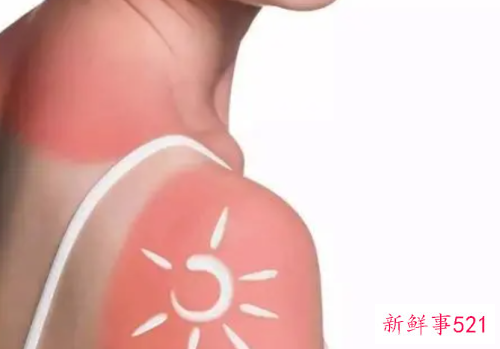 皮肤晒伤发红怎么办