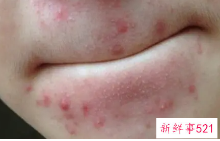 长痘痘要怎么内调排毒呢