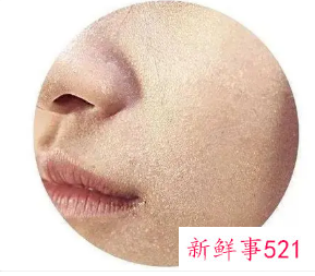 皮肤上有米粒白色凸起是怎么回事