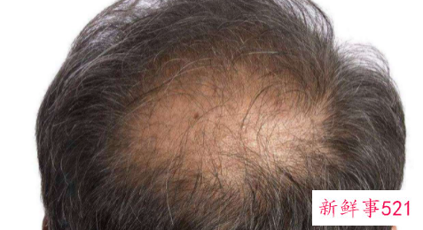 油性头发脱发怎样办