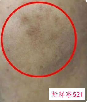 什么药可以去黑色素