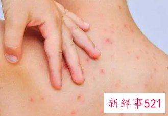 后背皮肤病种类