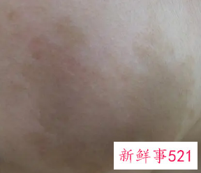 色素沉着自己能消吗