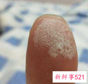 手指头有白点点