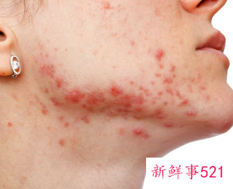 脸上长满闭口怎么办