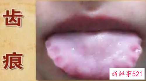 舌头齿痕严重吃什么药