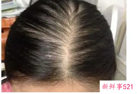 油性头发脱发怎样办