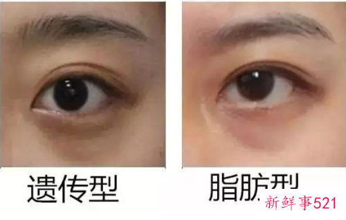 天生遗传眼袋怎么消除