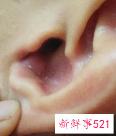 耳朵上长疙瘩是怎么回事