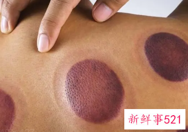 为什么拔罐后感觉超级累