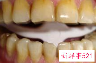 女性牙齿越来越黄怎么回事