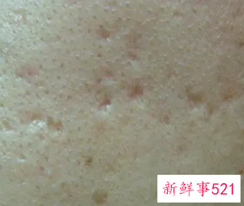 十几年的凹洞修复