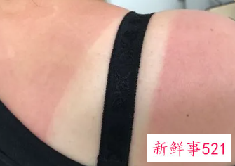 皮肤暴晒后又红又痛怎么处理小妙招
