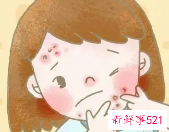 长青春痘后千万不可以做哪些事