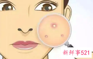 16岁青春痘5天内去掉小妙招