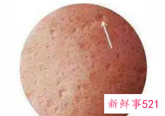 十几年的凹洞修复