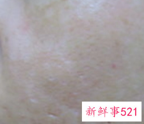 色素沉着自己能消吗