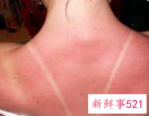 皮肤暴晒后又红又痛怎么处理小妙招