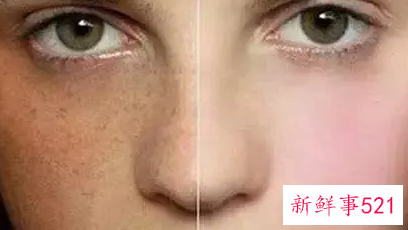 怎样淡化晒斑