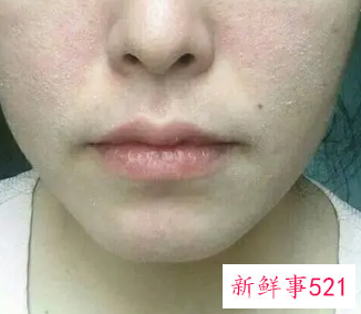 脸上干的起白皮该怎么办