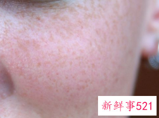 脸上长满闭口怎么办