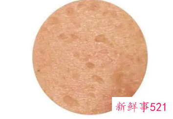 十几年的凹洞修复