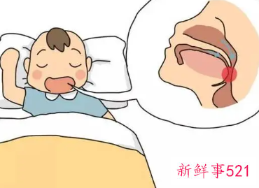 张嘴睡觉怎样纠正