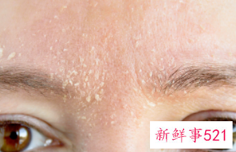 脸上干的起白皮该怎么办