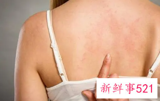 后背皮肤病种类