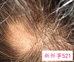 头皮有螨虫怎么办