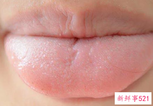 舌头齿痕严重吃什么药