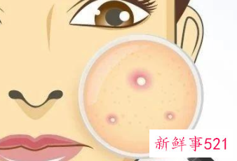 长青春痘后千万不可以做哪些事