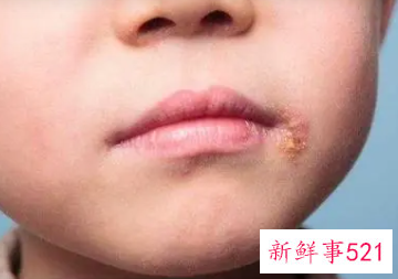 嘴角两边干燥脱皮是什么原因引起的