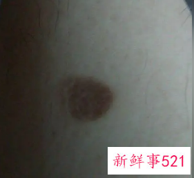 色素沉着自己能消吗