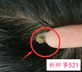 头皮有螨虫怎么办