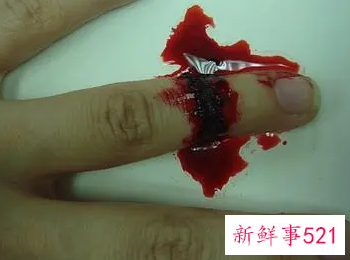 梦见自己身体溃烂流血