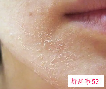 脸上起干皮吃什么水果