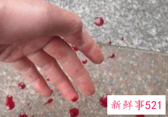 梦见自己身体溃烂流血