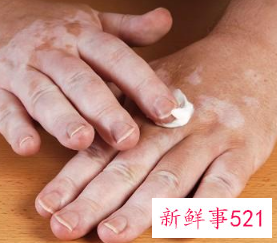 治疗白斑有效的土方法