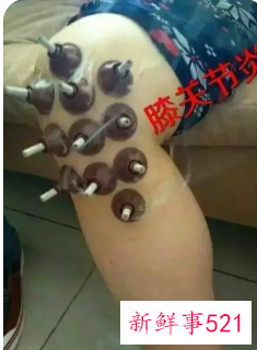 艾灸膝盖的好处和功效