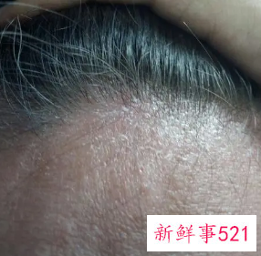 洗完头头皮屑还特别多怎么办