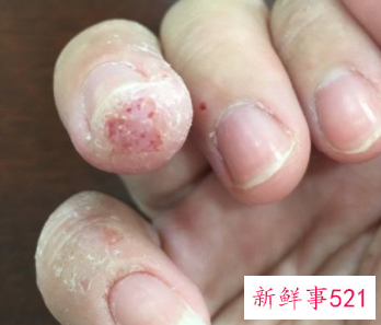 手指莫名其妙的痒是怎么回事