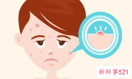 经期前后痘痘该如何护理