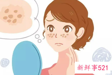 内调色斑用什么调理