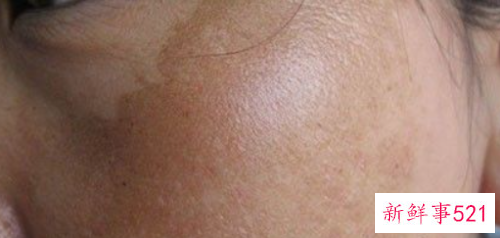 最靠谱的祛斑方法是什么