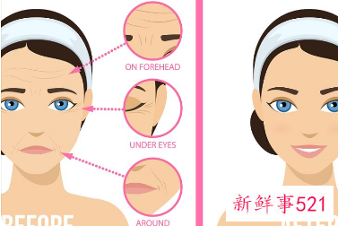 脸上脂肪填充有什么后遗症