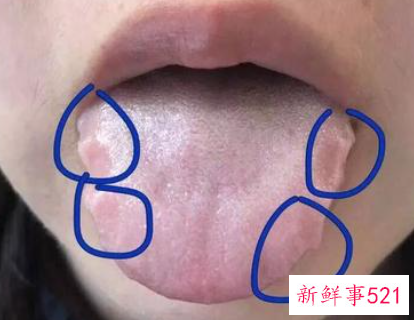 舌头齿痕严重吃什么药