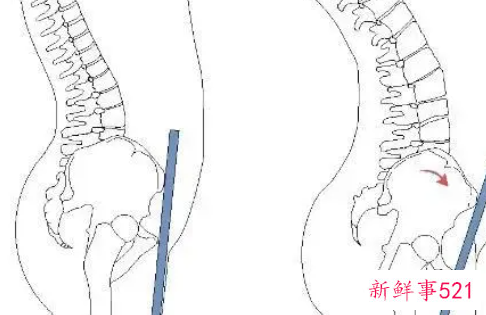 骨盆前倾垫枕头正确示意图