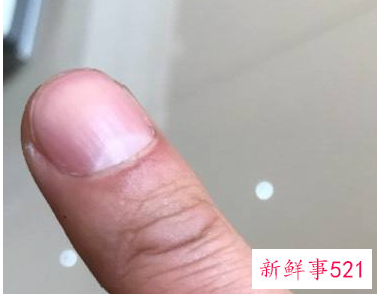 手指莫名其妙的痒是怎么回事