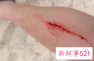 女人梦见下体出血